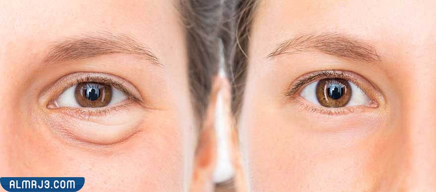 صور توضح قبل وبعد استخدام الفيلر لعلاج مشكلة العيون الغائرة