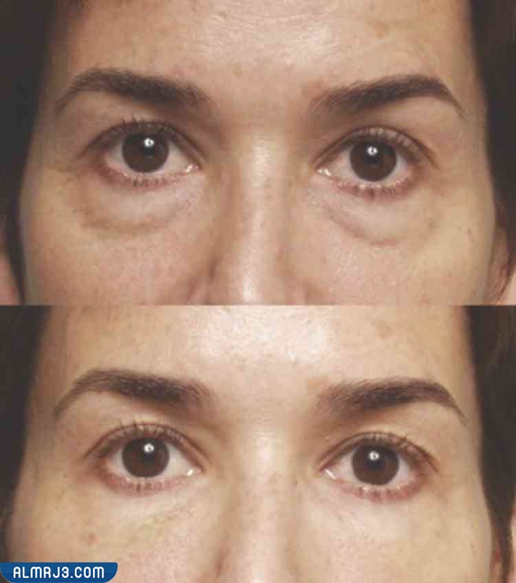 صور توضح قبل وبعد استخدام الفيلر لعلاج مشكلة العيون الغائرة