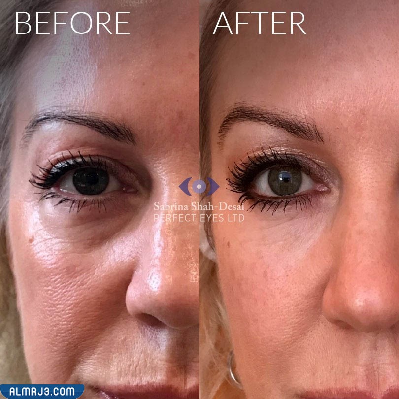 صور توضح قبل وبعد استخدام الفيلر لعلاج مشكلة العيون الغائرة