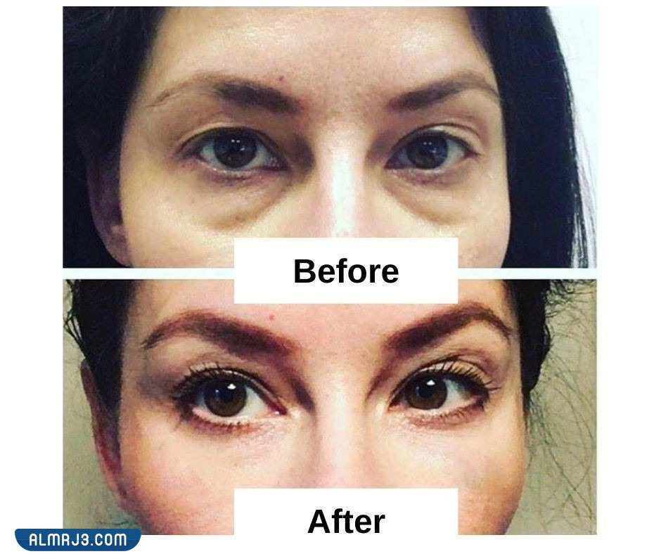صور توضح قبل وبعد استخدام الفيلر لعلاج مشكلة العيون الغائرة