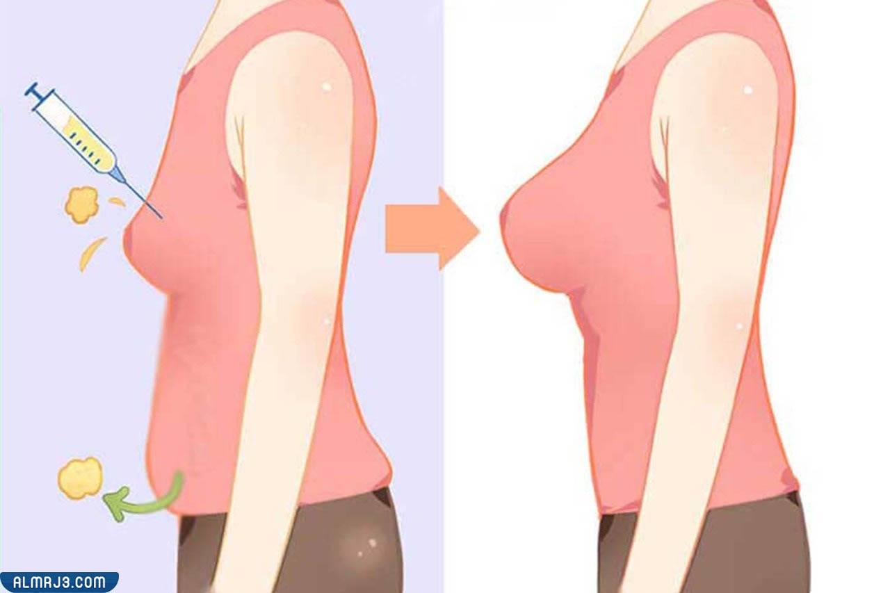 فوائد حقن الدهون الذاتية في الصدر