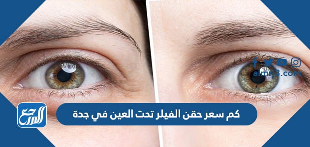 كم سعر حقن الفيلر تحت العين في جدة