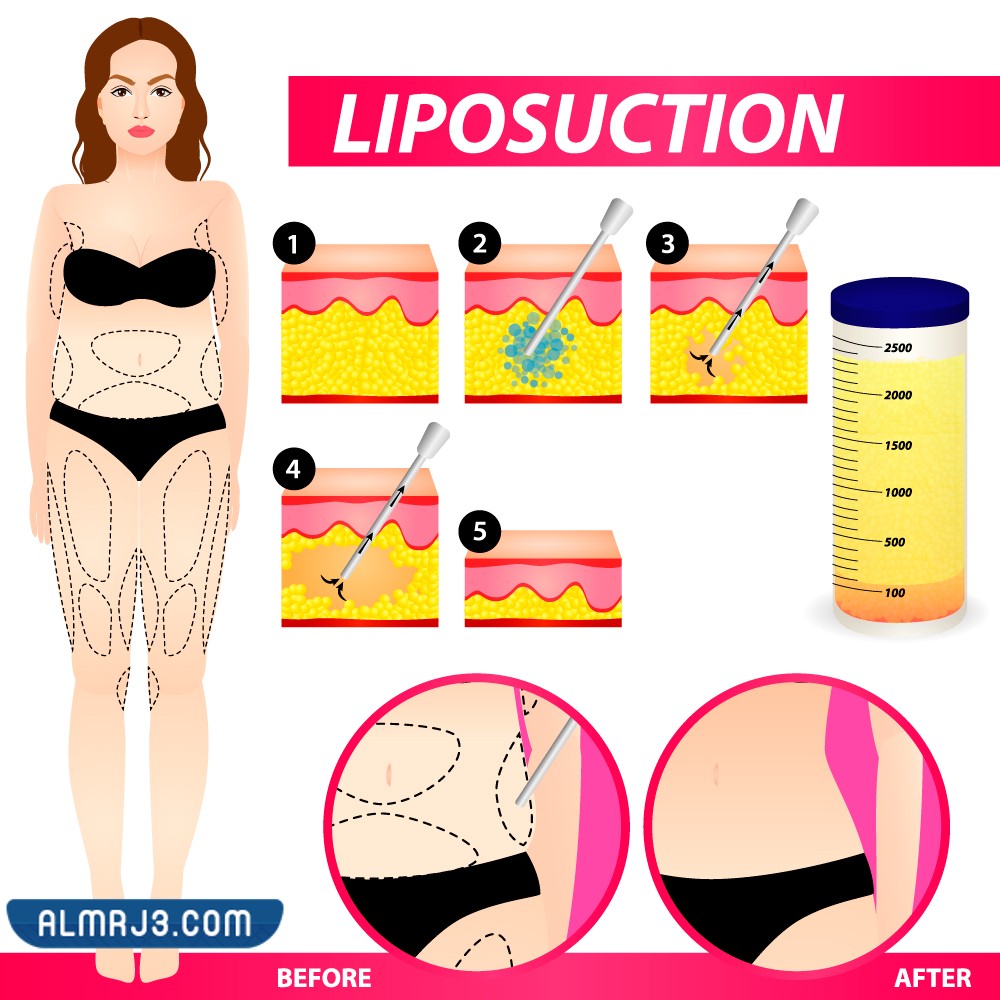 ما هو شفط الدهون الفيزر