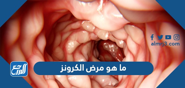 ما هو مرض الكرونز