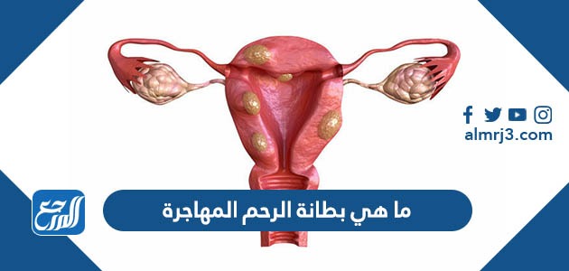 ما هي بطانة الرحم المهاجرة