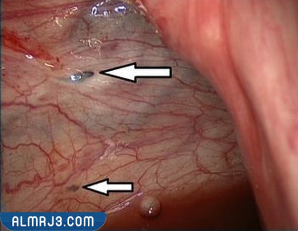 ما هي بطانة الرحم المهاجرة