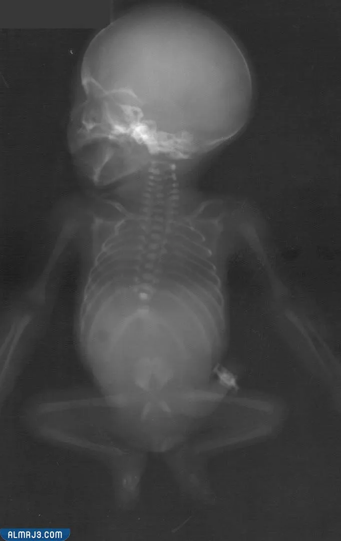 متلازمة التراجع الذيلي