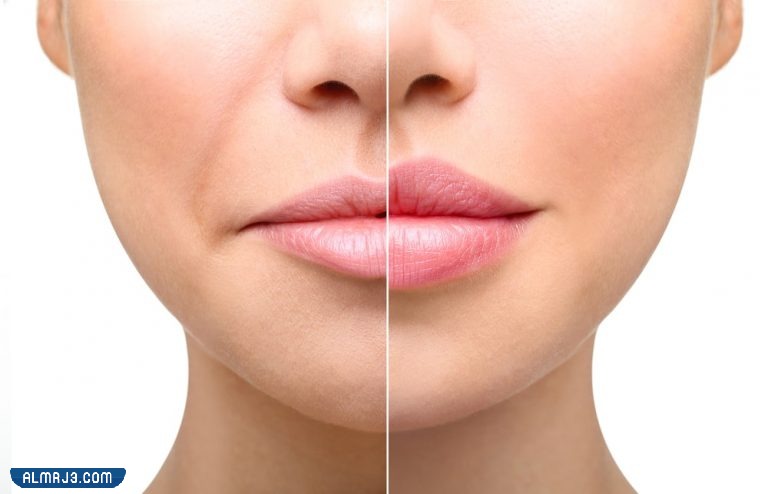 متى يبدأ الفيلر بالذوبان