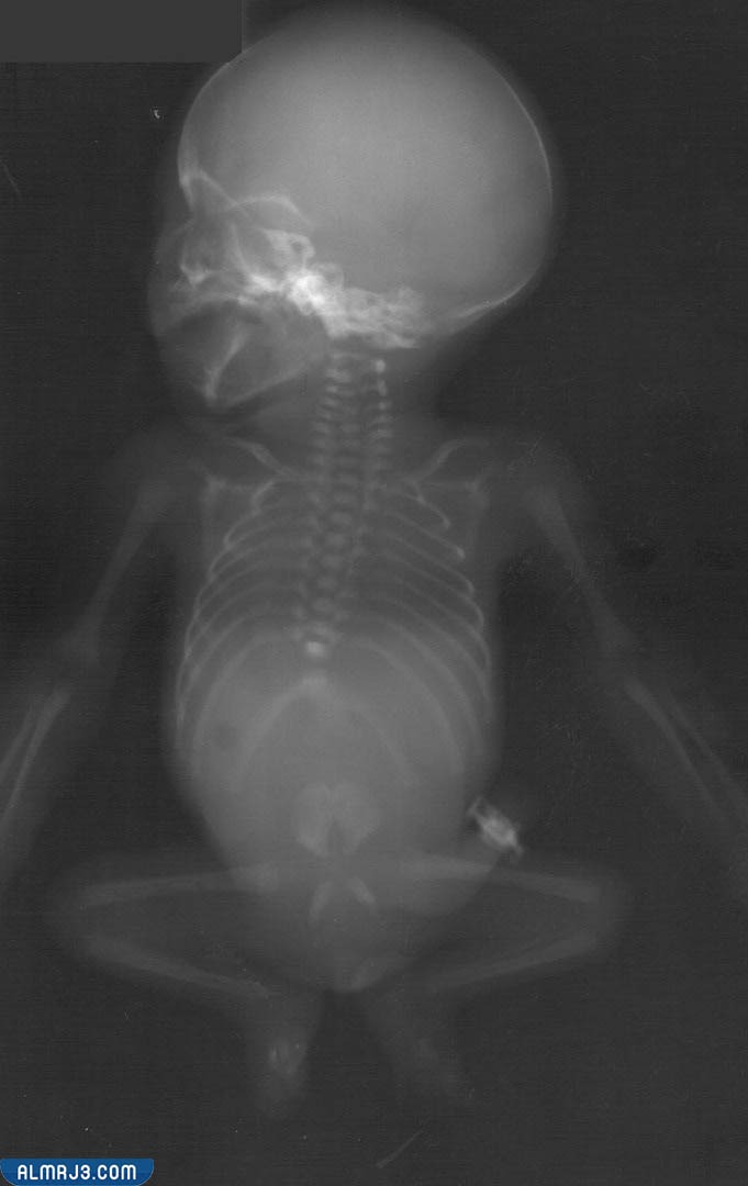 ما هي متلازمة التراجع الذيلي