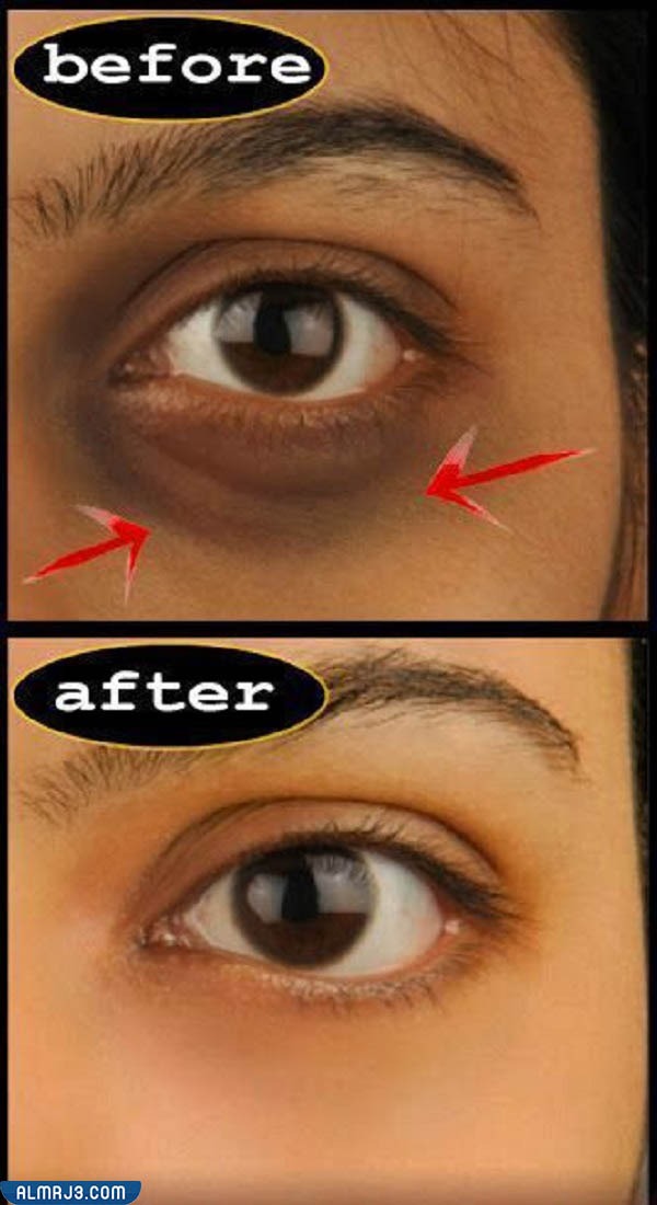 صور توضح قبل وبعد استخدام الفيلر لعلاج الهالات السوداء