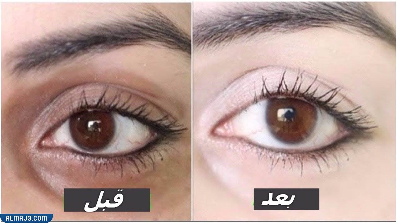 صور توضح قبل وبعد استخدام الفيلر لعلاج الهالات السوداء