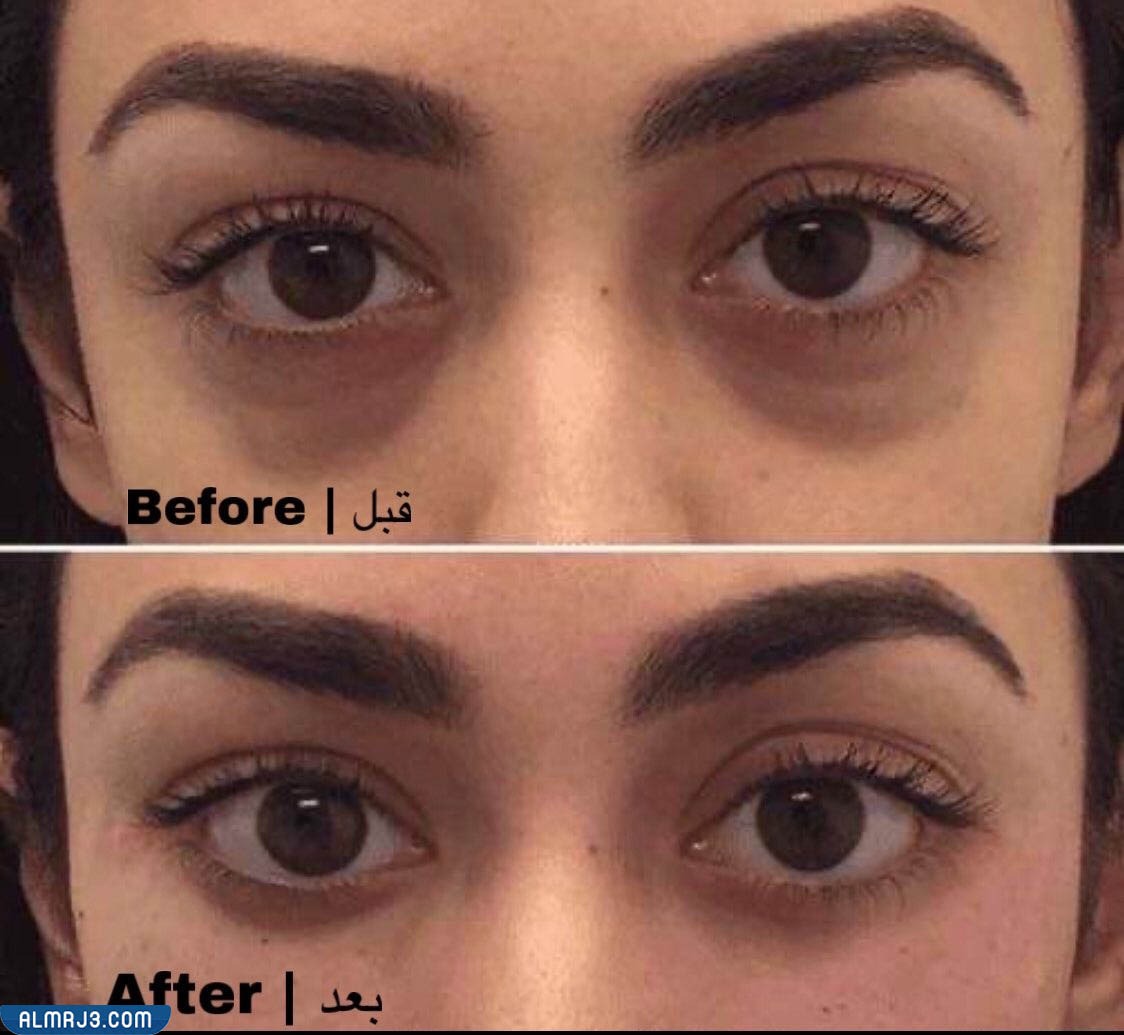 صور توضح قبل وبعد استخدام الفيلر لعلاج الهالات السوداء