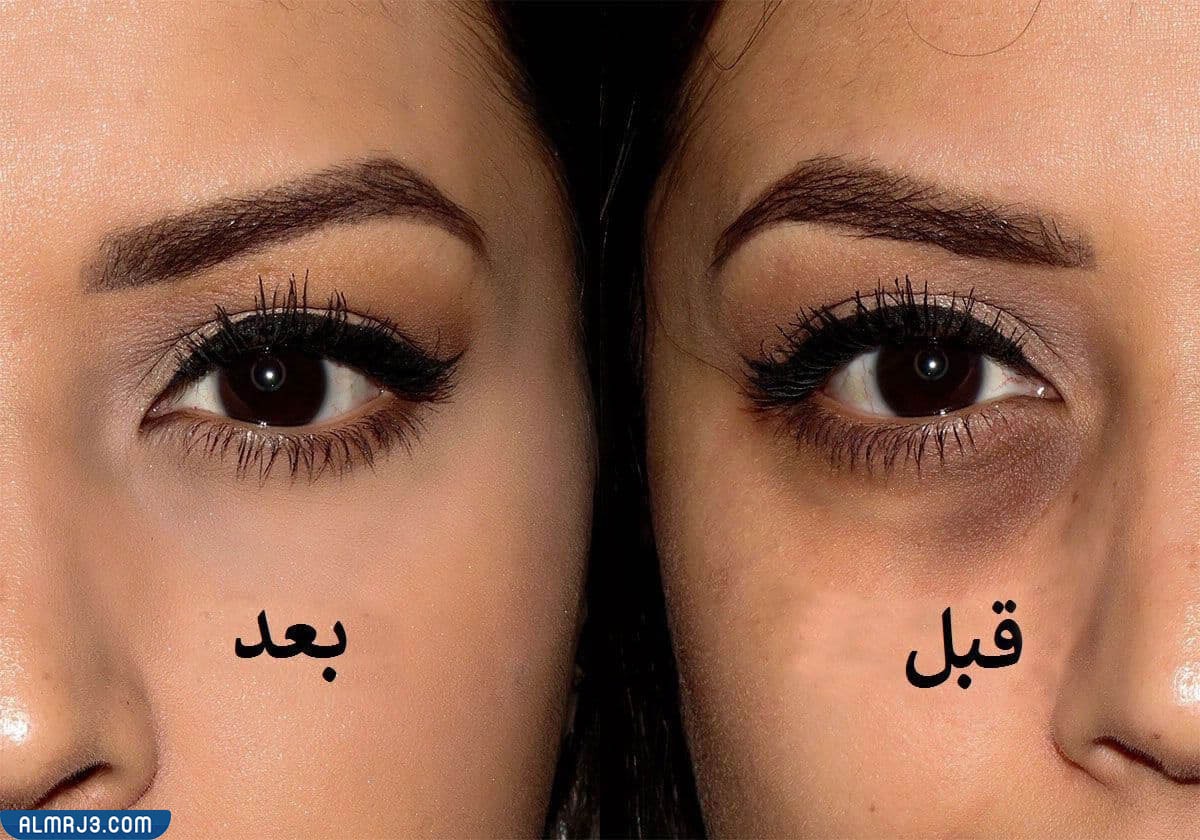 صور توضح قبل وبعد استخدام الفيلر لعلاج الهالات السوداء