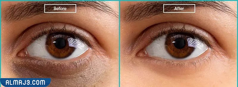 صور توضح قبل وبعد استخدام الفيلر لعلاج الهالات السوداء