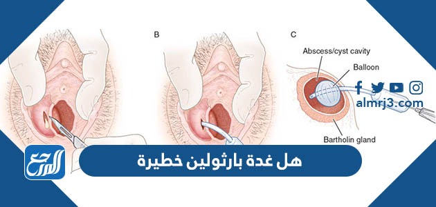 هل غدة بارثولين خطيرة