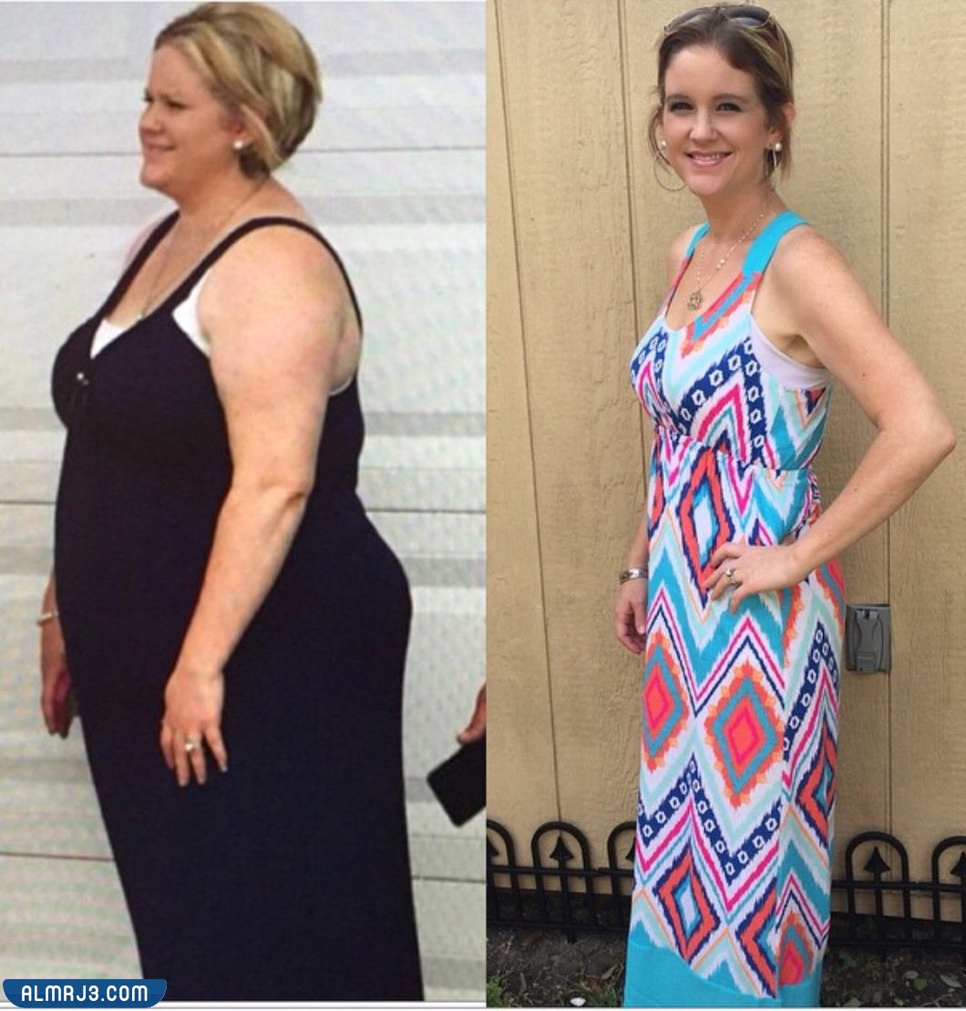 تكميم المعدة قبل وبعد 4