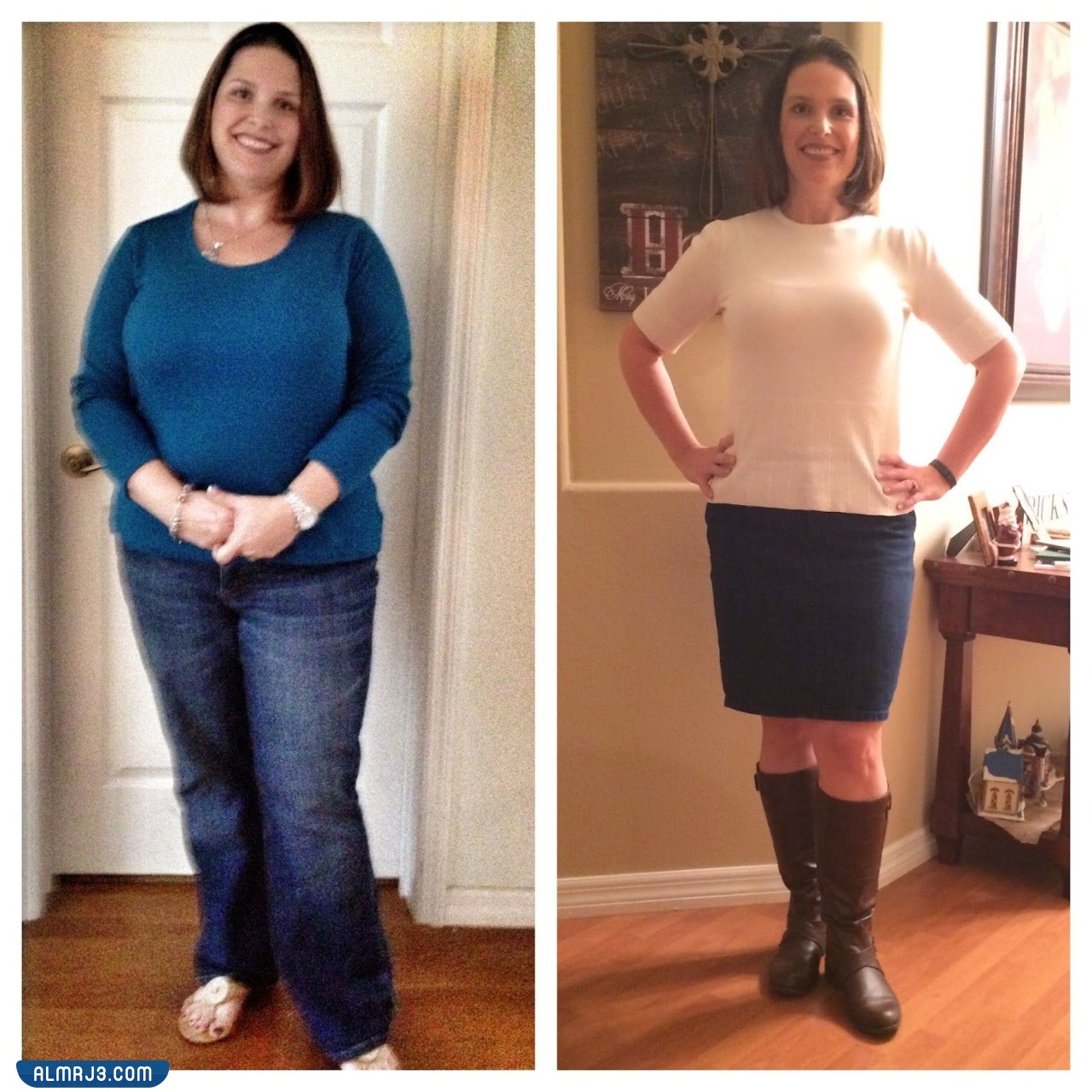 تكميم المعدة قبل وبعد 5