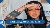 خشم نجلاء الودعاني قبل وبعد خشم نجلاء الودعاني قبل وبعد