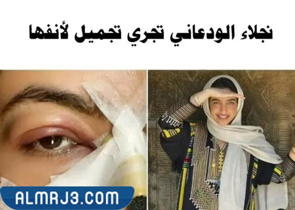 خشم نجلاء الودعاني قبل وبعد