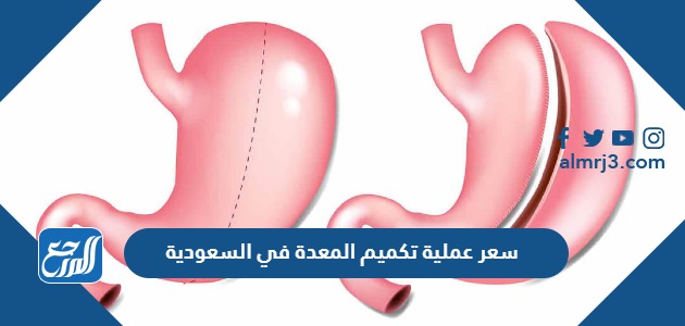 سعر عملية تكميم المعدة في السعودية 