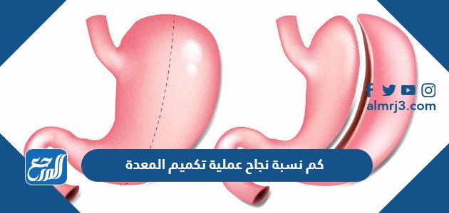 كم نسبة نجاح عملية تكميم المعدة