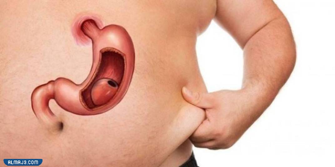 ما هي عملية تكميم المعدة