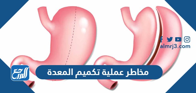 مخاطر عملية تكميم المعدة