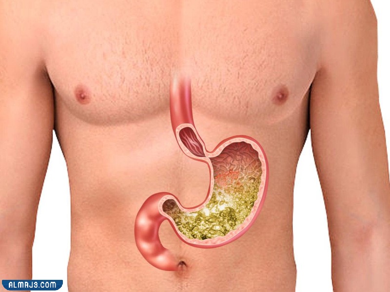 نصائح بعد عملية تكميم المعدة وزني 90