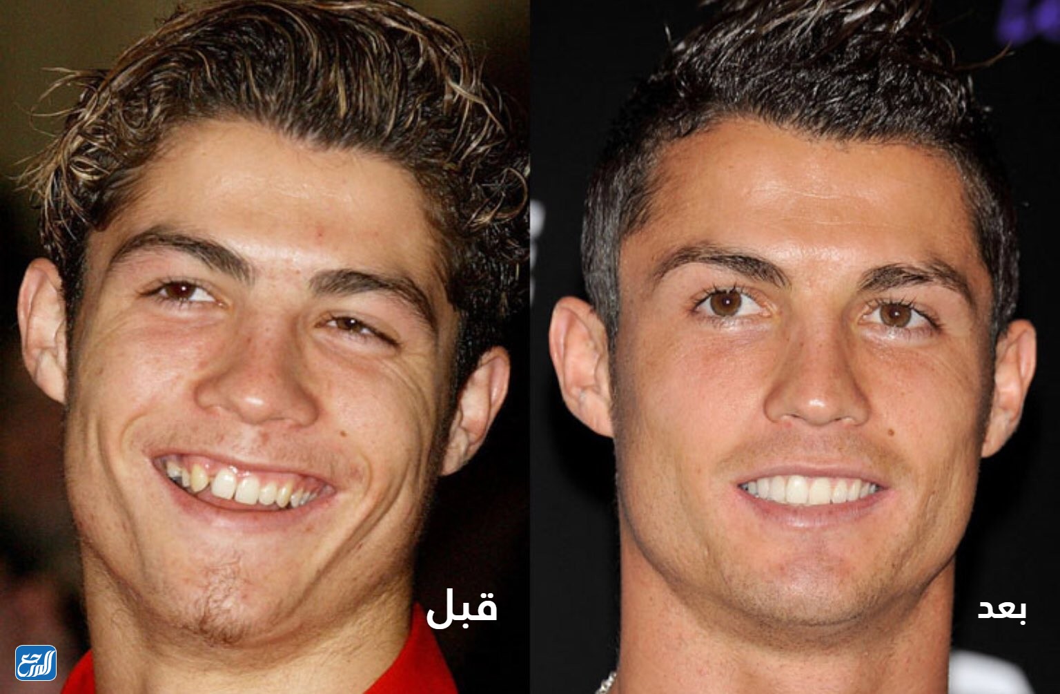 كريستيانو قبل عملية التجميل