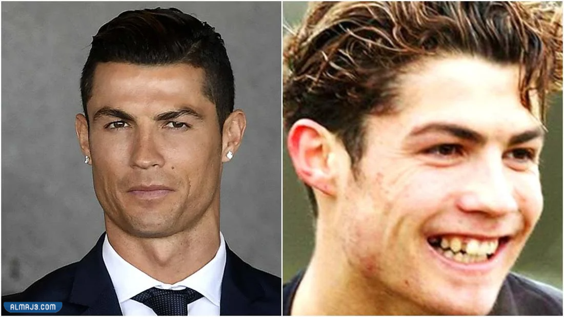 كريستيانو قبل وبعد التجميل